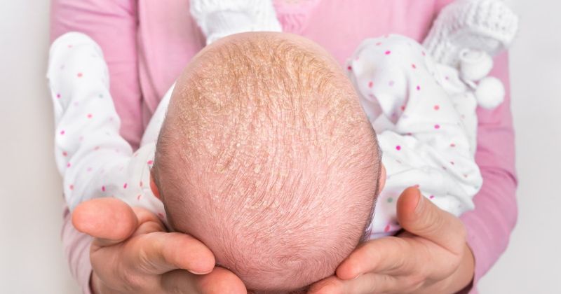 Baby-trockene Kopfhaut